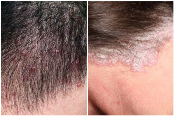 Vảy nến da đầu - Hình ảnh minh họa